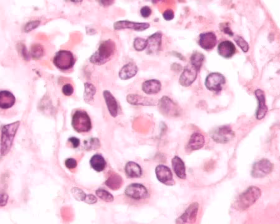 Parvovirus zainfekowane czerwone krwinki