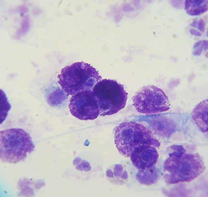 Komorki nowotworowe - cytologia